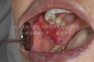 盘状红斑狼疮口腔溃疡口腔红斑口腔白斑